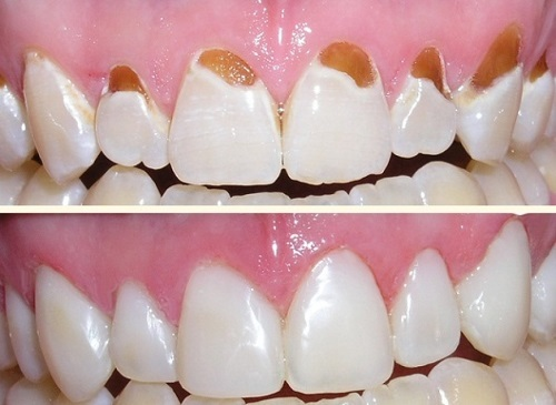 Tại sao nên thường xuyên lấy cao răng