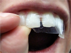 Miếng dán làm trắng răng chuyên dùng có thực sự an toàn?